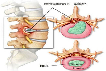 腰椎间盘脱出:腰椎间盘里的髓核通过破裂的纤维环以及椎间隙,游离到