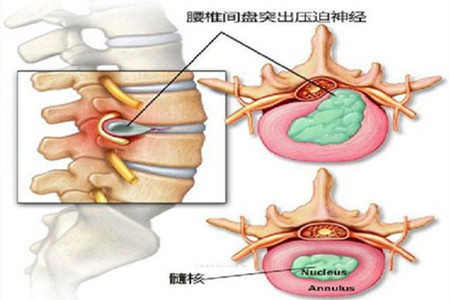 腰椎间盘里的髓核通过破裂的纤维环以及椎间隙,游离到椎管内,压迫硬膜