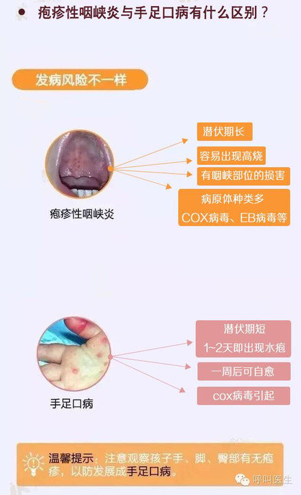 怎么区分宝宝是口腔溃疡还是手足口疱疹性咽颊炎