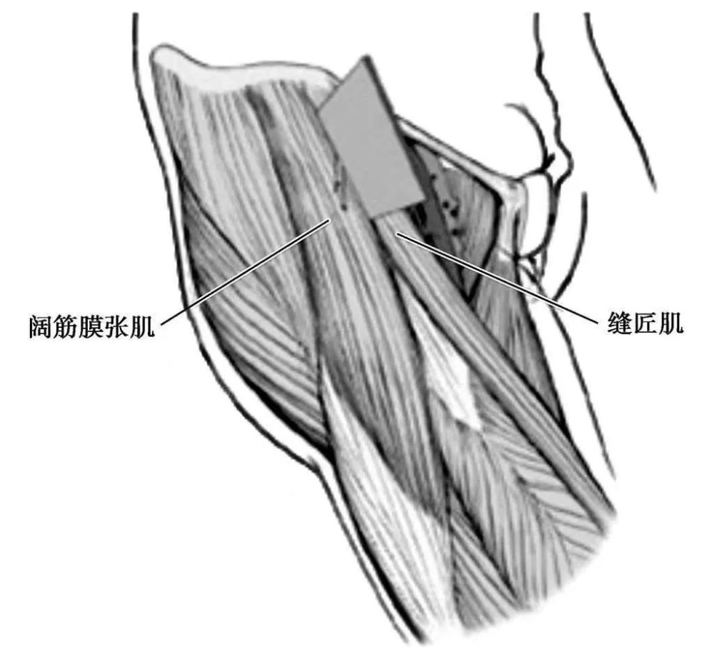 该入路主要利用两个神经界面:浅层经缝匠肌(股神经支配)和阔筋膜张肌