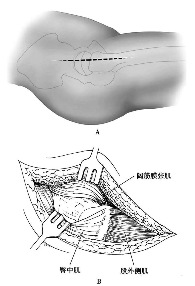 该入路经臀中肌及阔筋膜张肌间隙进入(图5).
