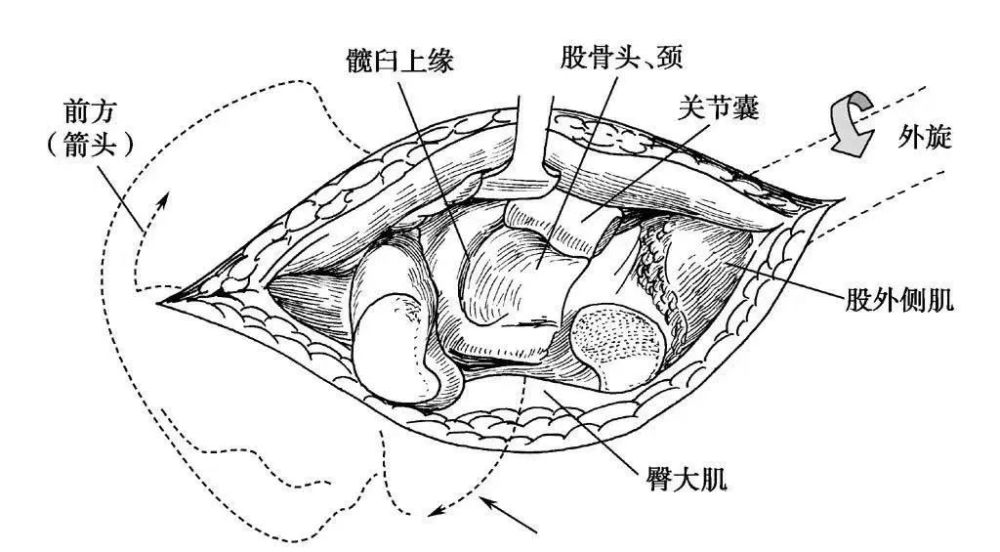 骨科精读|从髋关节的解剖到手术入路全过程,你要的解答全在这!