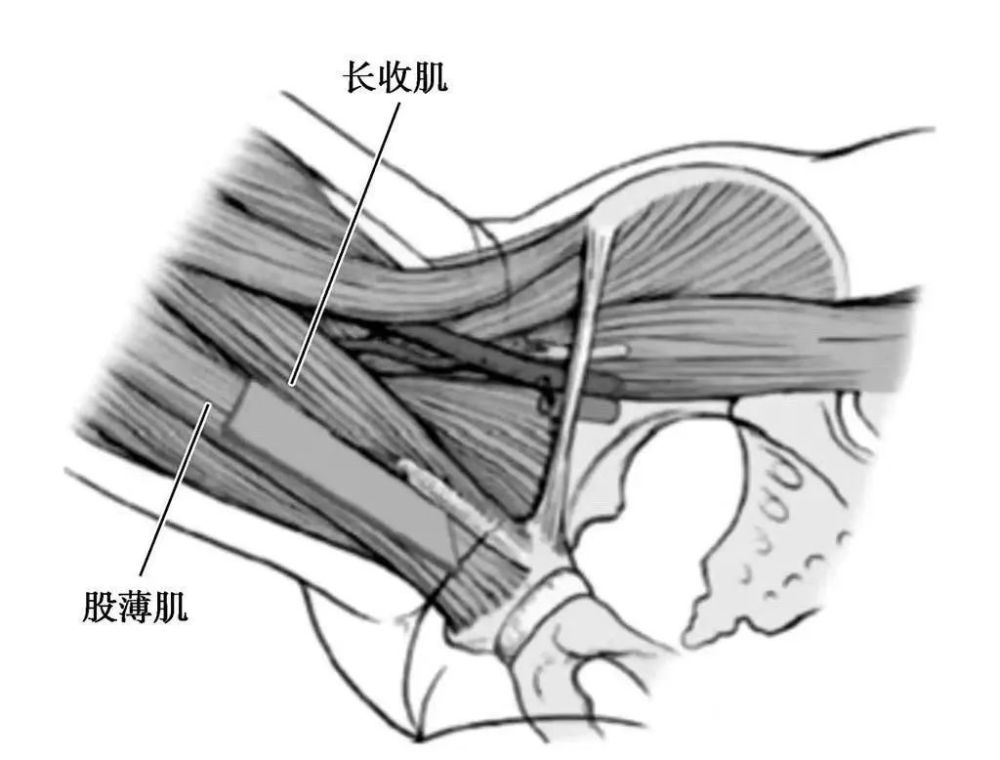 03 操作要点 图19 髋关节内侧入路局部解剖 沿皮肤切口切开筋膜,沿长