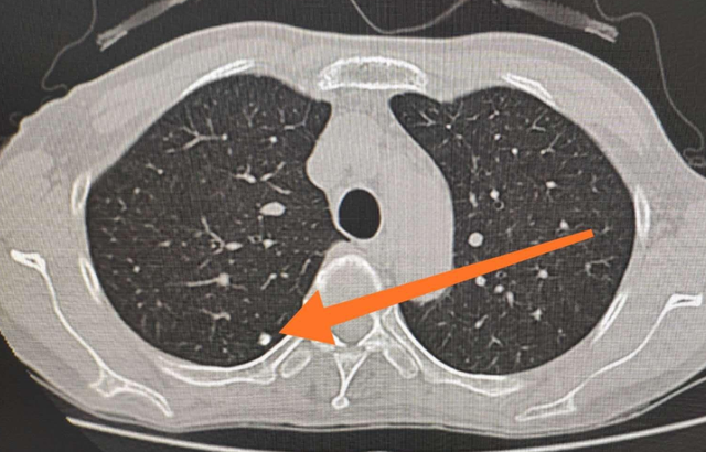 医生教你3个方面正确认识肺部结节