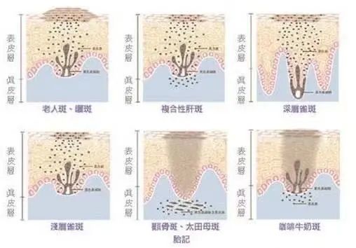 表皮斑相对来说都是很好去除的,基本治疗方法如下: 治疗项目:光子