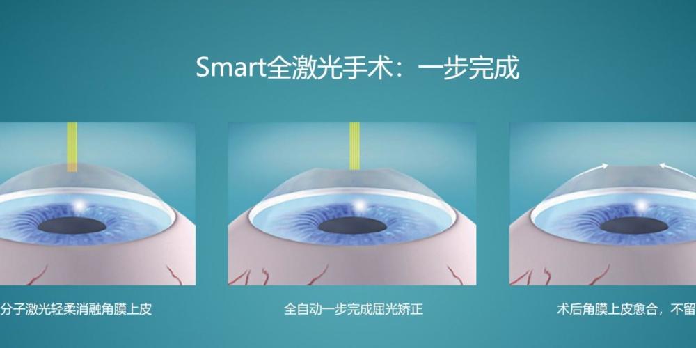 smart全激光比全飞秒好么