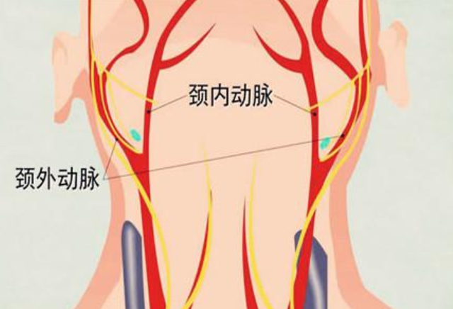 然而静动脉要比其他的大动脉更狭窄一些,如果血管当中出现杂质的话,颈