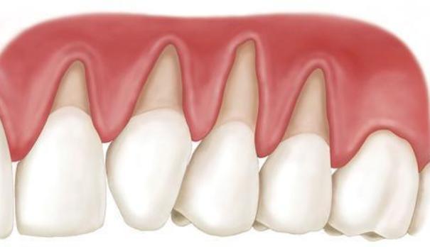 牙龈萎缩危害大,3大原因要引起警惕,第一个或许你还在