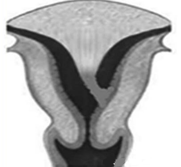 部分盲角子宫有发育不完全的阴道,但又不和正常阴道相通,形成阴道积血