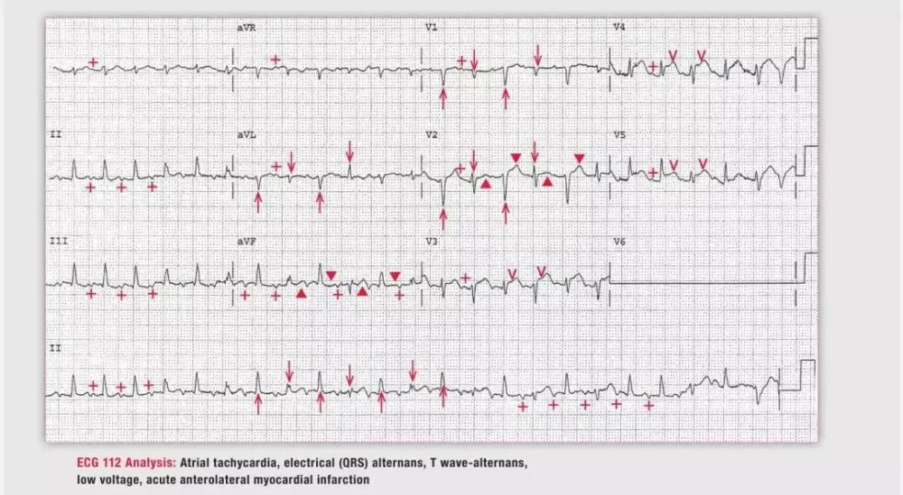 诊断:房性心动过速,电交替(qrs),t波交替,低电压,急