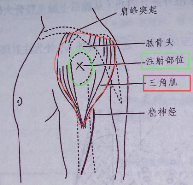 肌内注射:三角肌定位法 最后,我们结合实际案例来复习一下上臂三角肌