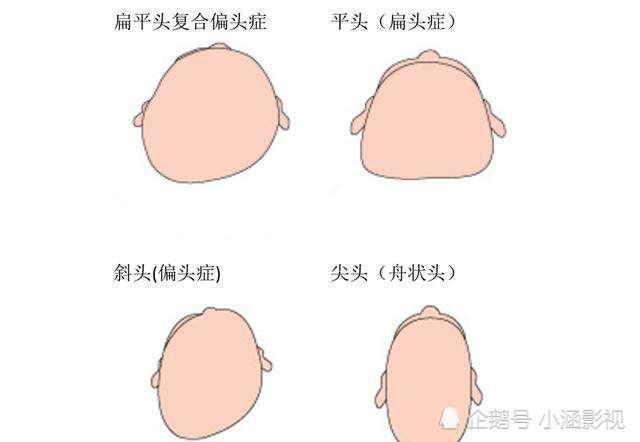 科学证实:圆头更健康,别把婴儿头形睡