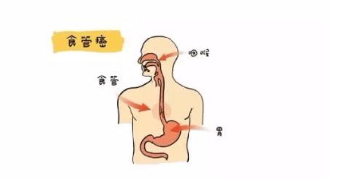 食管癌产生的三个原因,做到这6个方面,提前预防食管癌的出现