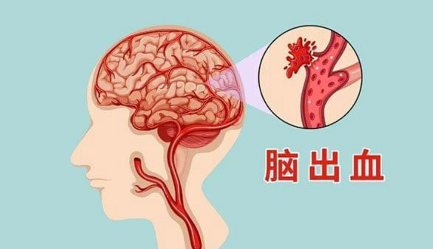 随着脑梗年轻化的普遍现象出现,越来越多的年轻人,会将脑梗的预防提上
