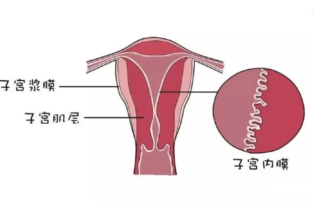 最常发生扭转的是带蒂浆膜下子宫肌瘤.