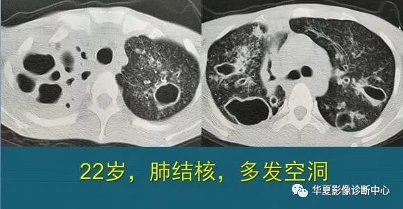 怎样从ct片上看出肺结核患者有没有传染性注意这3种征象
