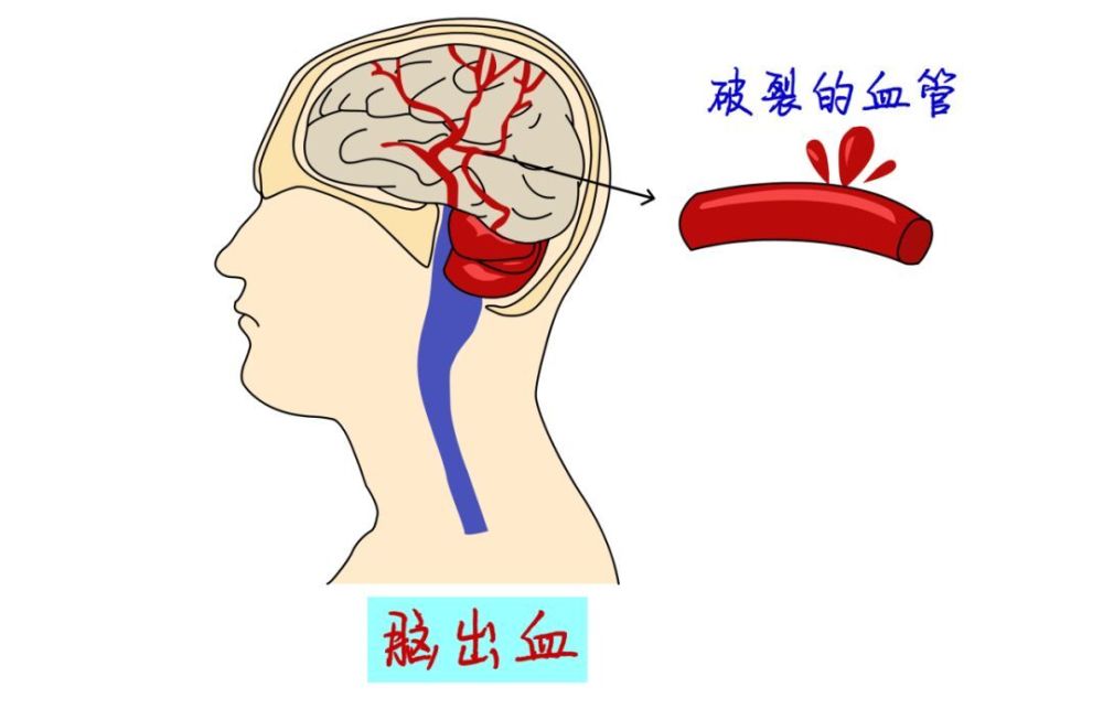 降压药怎么吃35岁男子任性吃药竟突发脑出血