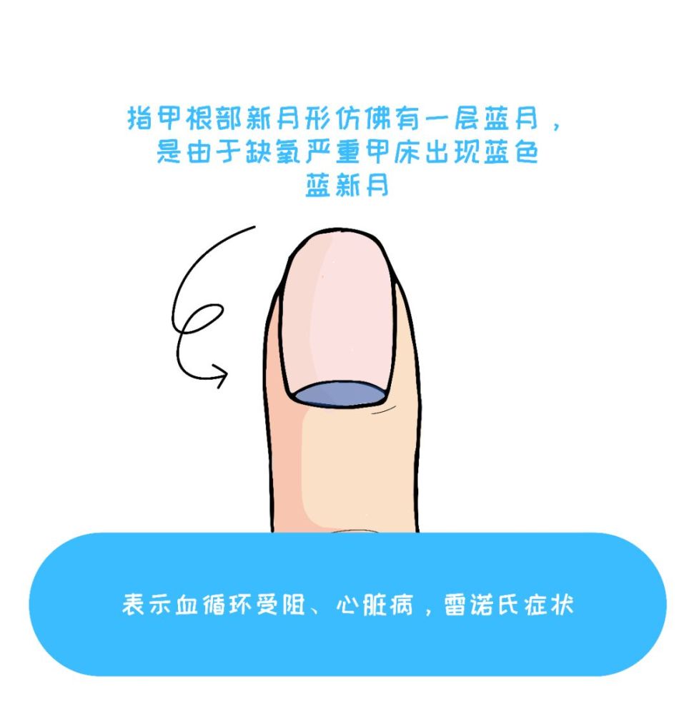 4)林赛氏指甲 总有人想害我的指甲? 1)指甲"被针扎了" 指
