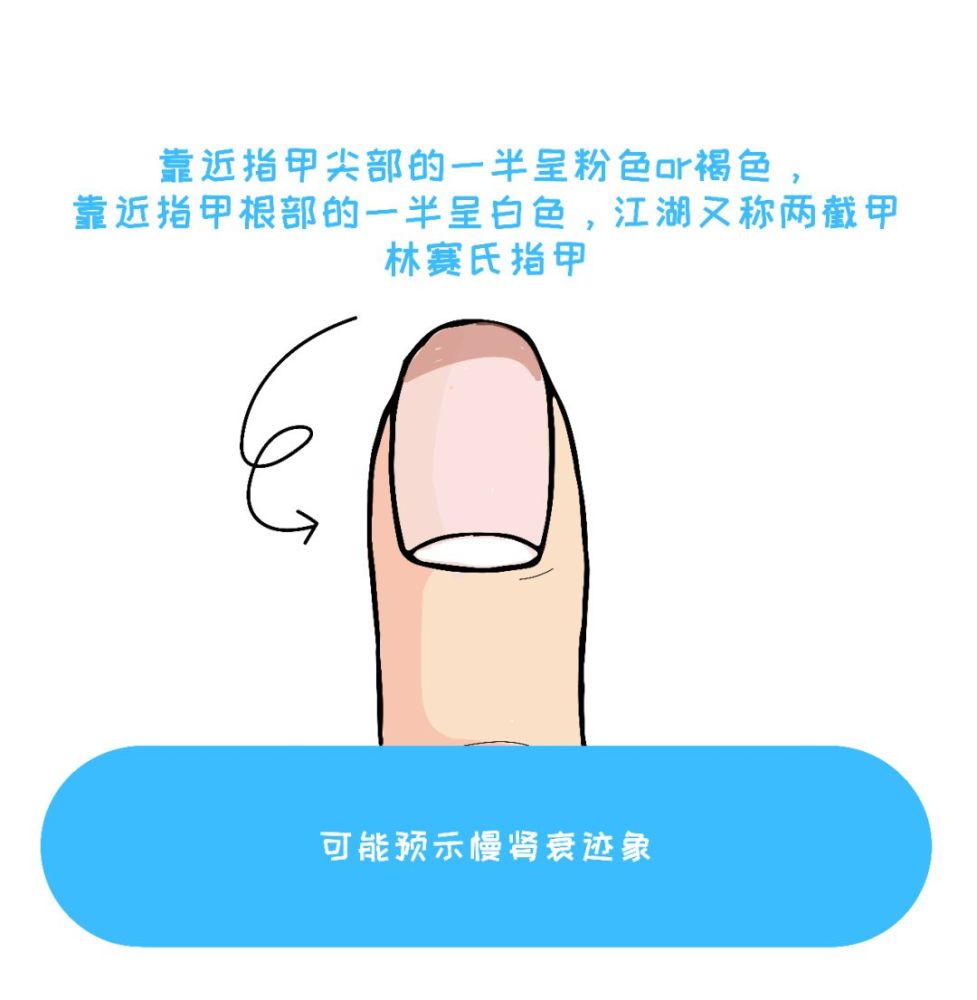 长纵纹意味着什么?一文教你看指甲识健康