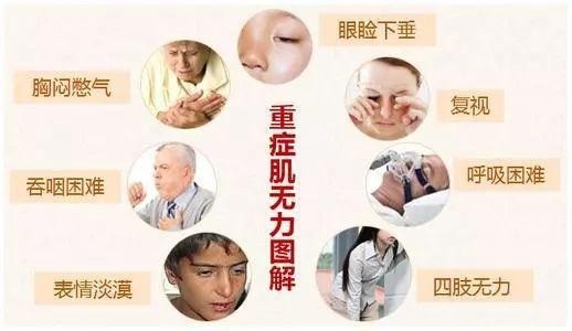 【疾病科普】眼肌型重症肌无力都有哪些症状?应该怎么样治疗效果好?