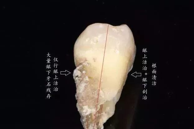 隐形的牙齿杀手!龈下结石到底有多可怕|牙齿|牙石|龈下结石|牙龈