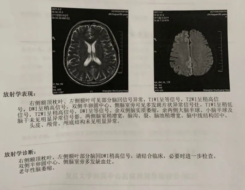 金老师被女儿和老公带到了附近医院, 核磁共振提示大脑皮层异常信号.