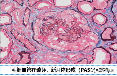 l  光镜:ii型常伴有肾小球毛细血管内皮细胞和系膜细胞增生,Ⅰ型和Ⅲ