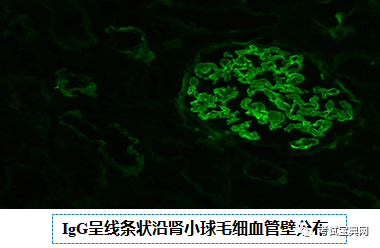 Ⅰ型和Ⅲ型无电子致密物l 光镜:ii型常伴有肾小球毛细血管内皮细胞和