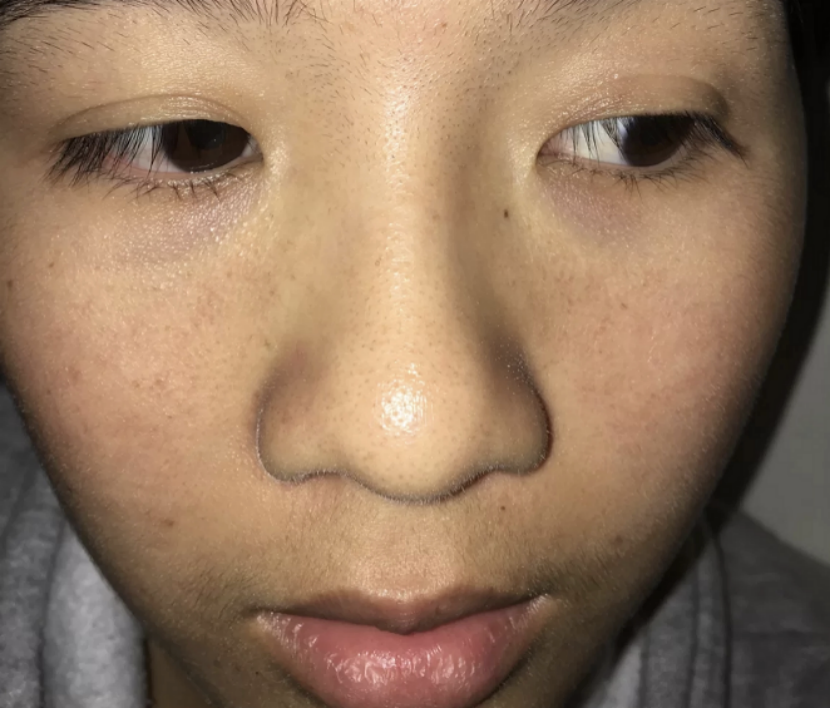 吴小姐25岁,因为工作压力和家庭压力的原因,经常熬夜,皮肤缺乏保养