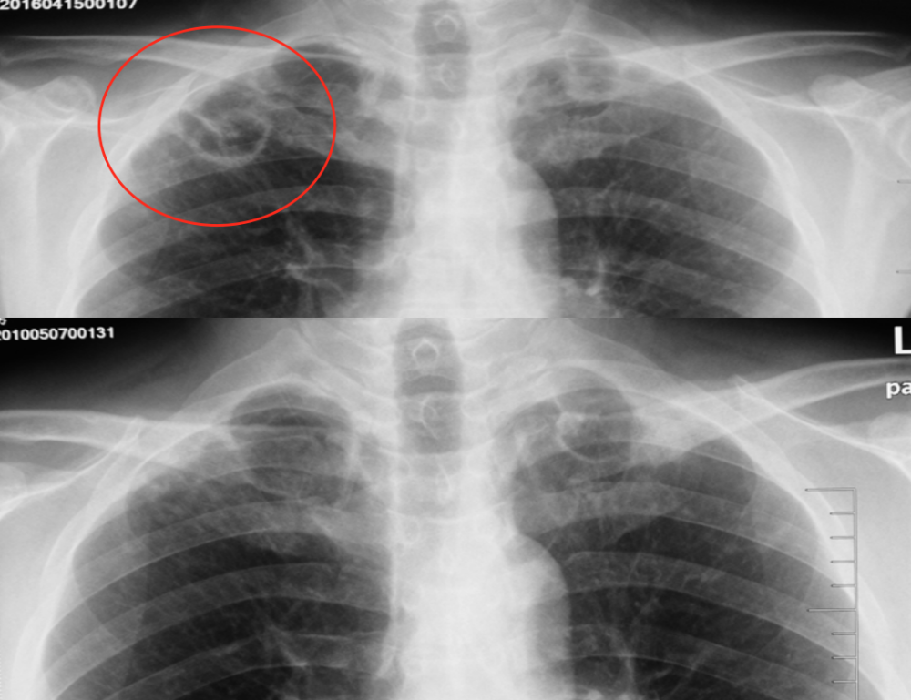 总体来说,肺结核的x线胸片表现的最大特点就是 上图所示,2016年胸片