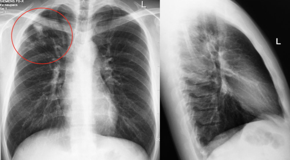 陈起航教授:肺结核的影像学评价——遏制,终止,终结肺结核(2)