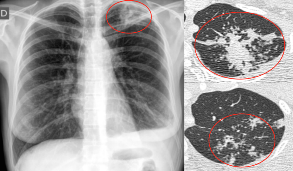 陈起航教授:肺结核的影像学评价——遏制,终止,终结肺