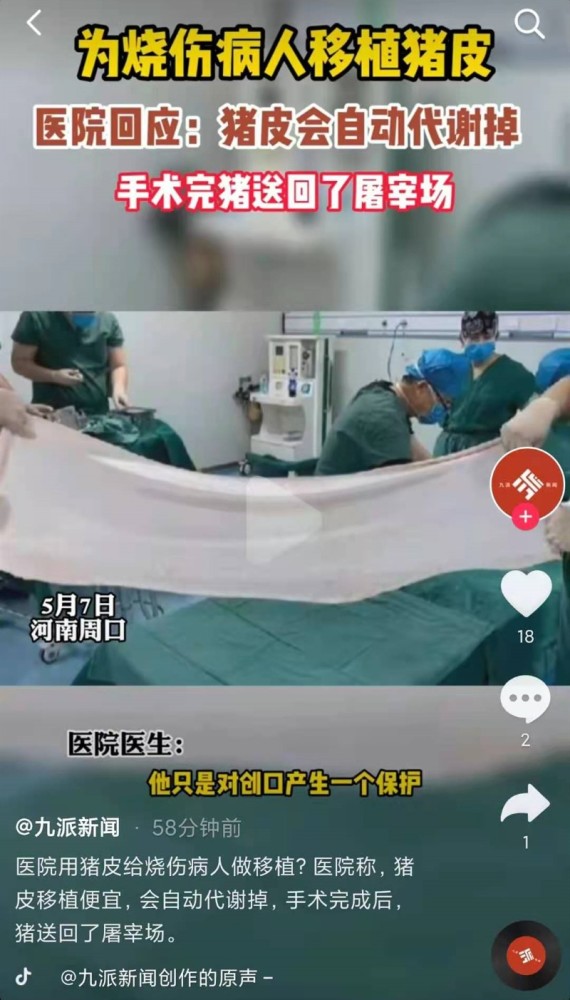 小伙96%烧伤,医院移植猪皮救命,医生:老技术了,费用低