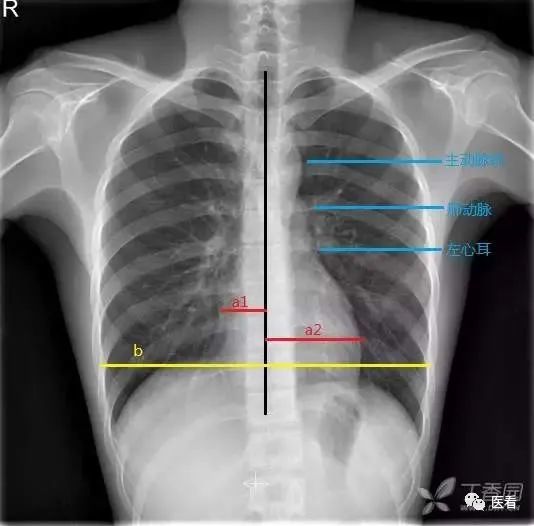 心脏横径/经右侧膈肌顶端测量的胸廓内壁横径,即 (a1 a2)/b ,正常值为