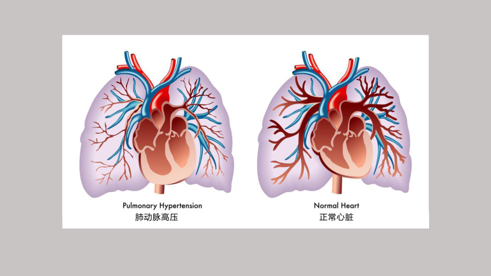 肺动脉高压的分类