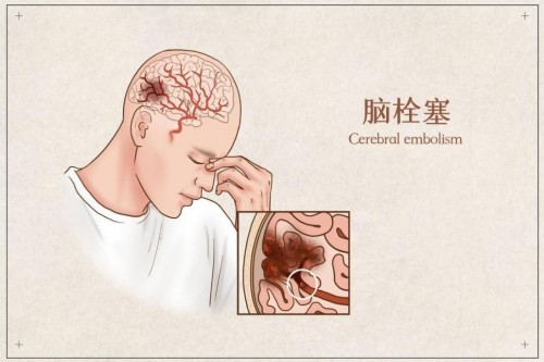 脑血栓后遗症是由什么原因引起的?了解原因,合理用药缓解后遗症