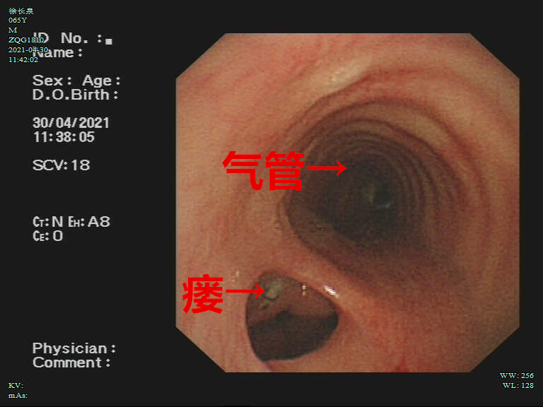 这种手术在我市首次开展,当食管和气管不能各行其道
