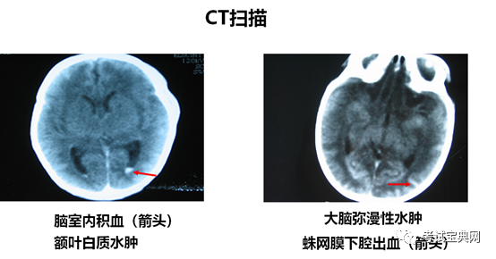 冠状切面:脑实质回声明显增强,侧脑室变窄几近消失 图1 示脑实质弥漫
