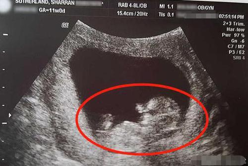女子怀孕14周流产,"胎儿"照片曝光!指甲盖都能看得清清楚楚