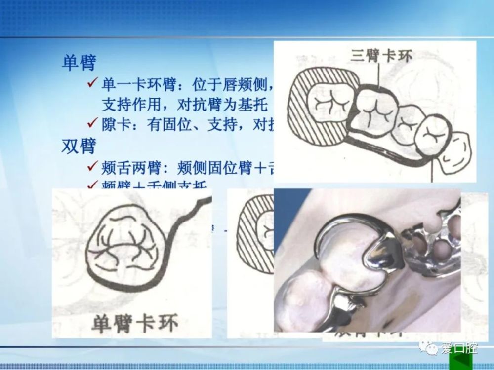 可摘局部义齿中卡环的种类