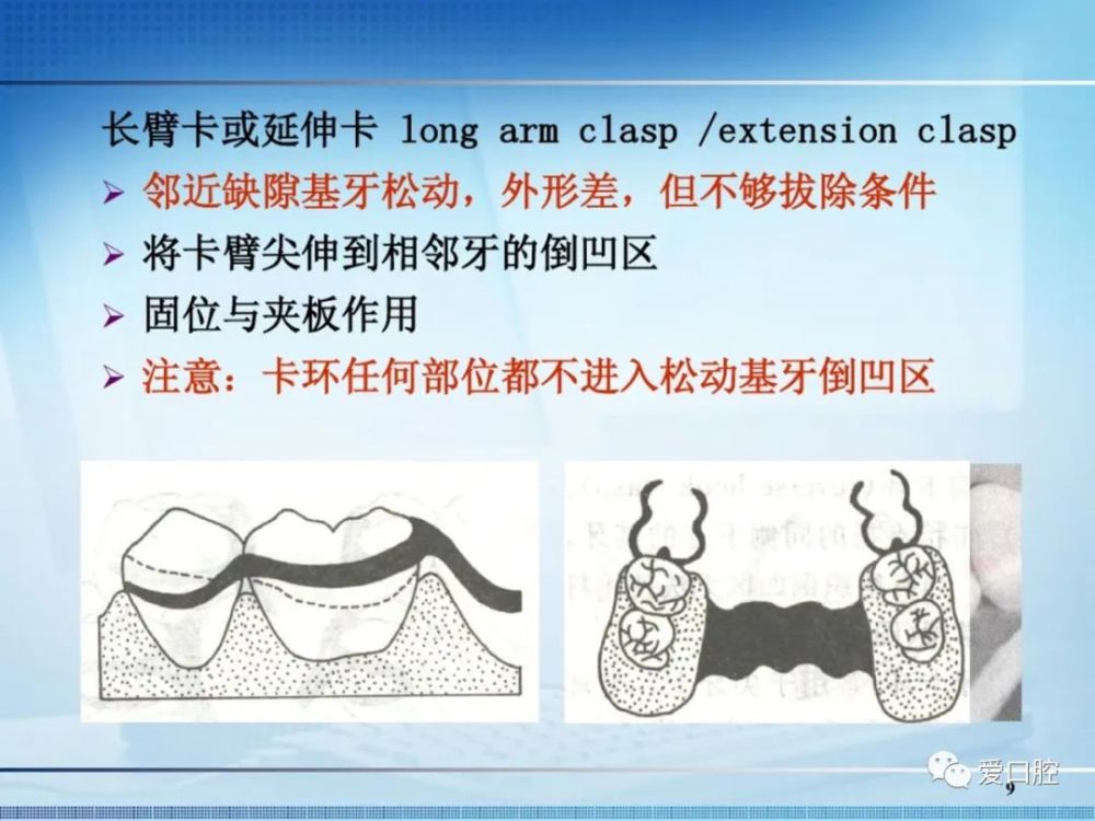 往期推荐 可摘局部义齿 可摘局部义齿的设计 弯制卡环的材料,原则及