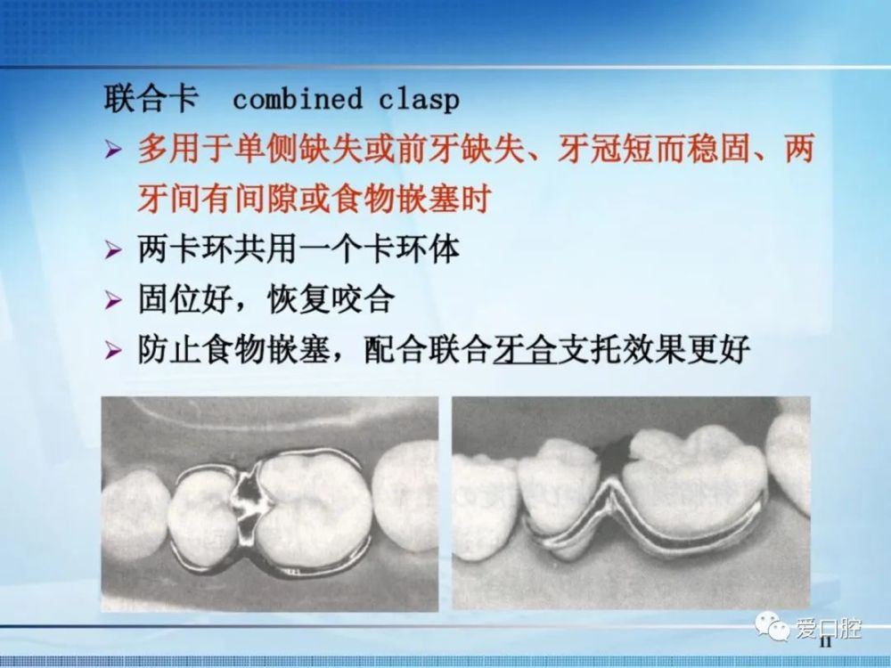 往期推荐 可摘局部义齿 可摘局部义齿的设计 弯制卡环的材料,原则及