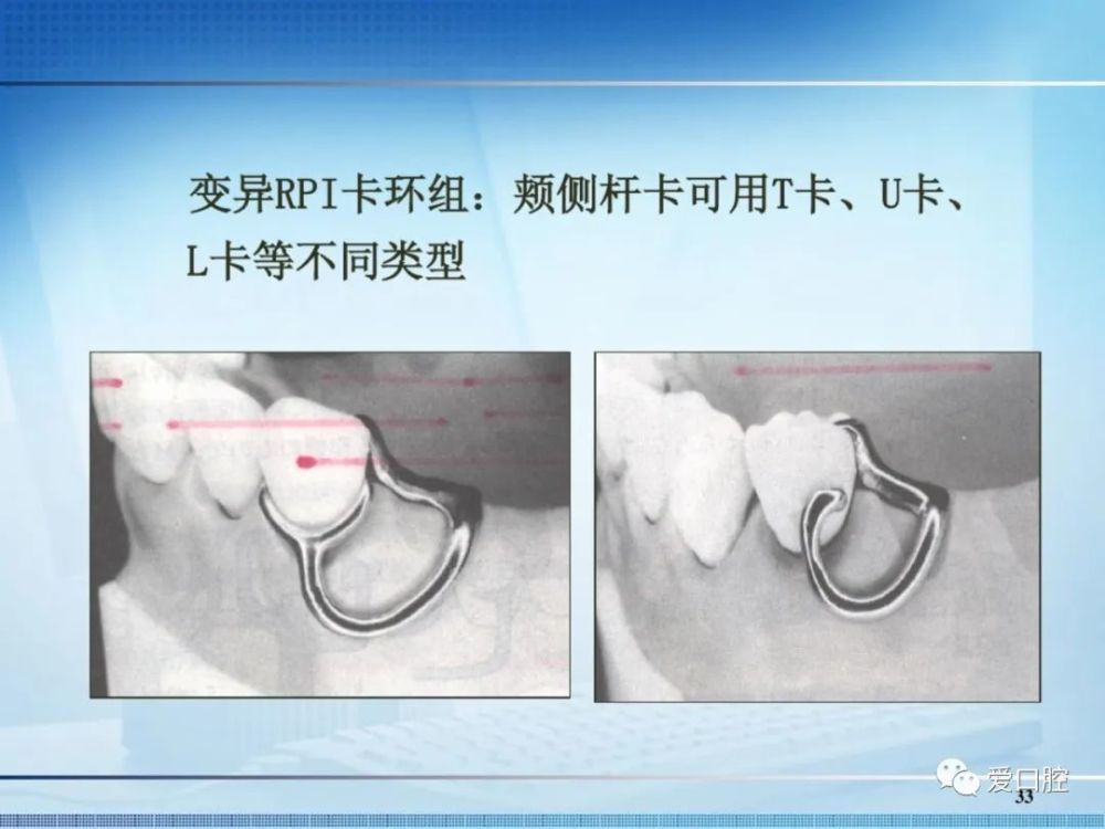 可摘局部义齿中卡环的种类