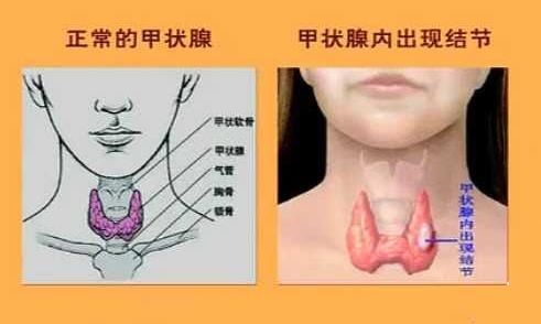 甲状腺结节越来越多,究竟是为什么?