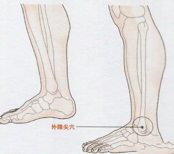 外踝尖:治疗腓肠肌痉挛,脚气,牙痛