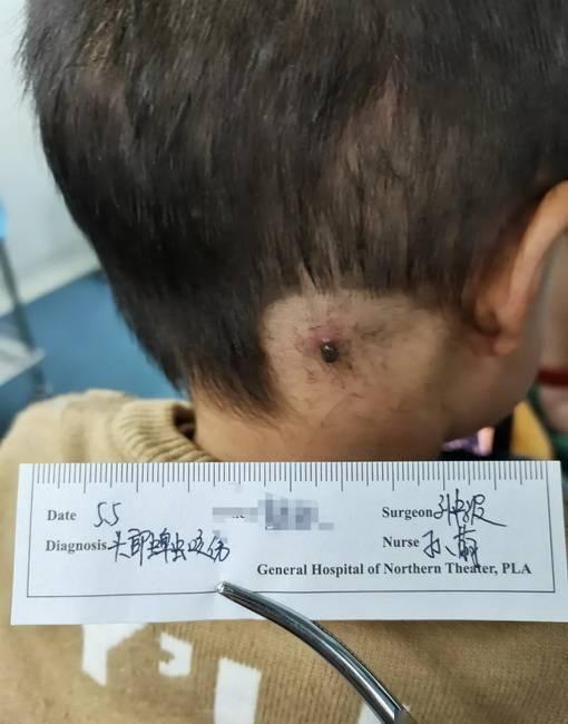 2岁小孩被蜱虫吸血多天,虫子涨大几十倍,取下来还活着