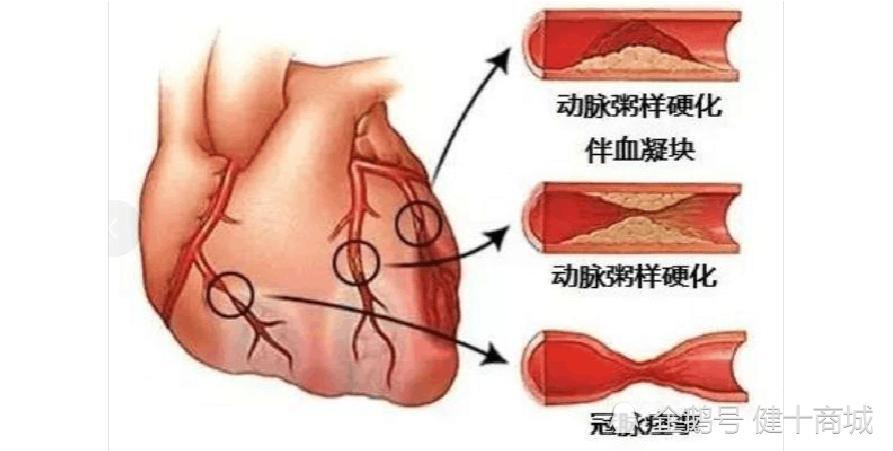 冠状动脉硬化(图片源自百度网路)