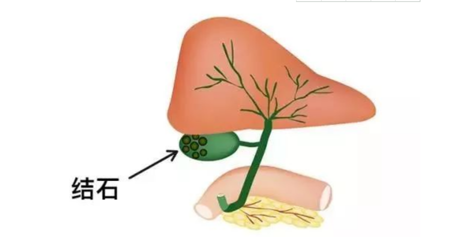 胆结石爱找这几类人群,生活中多注意4个方面,可以远离胆结石