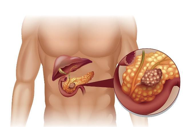 胰腺癌为何被称为癌王若身体有这4个反应最好别忽视