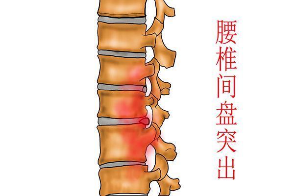 腰椎间盘突出是生活中,一种常见的腰椎疾病,导致这种疾病的原因主要与